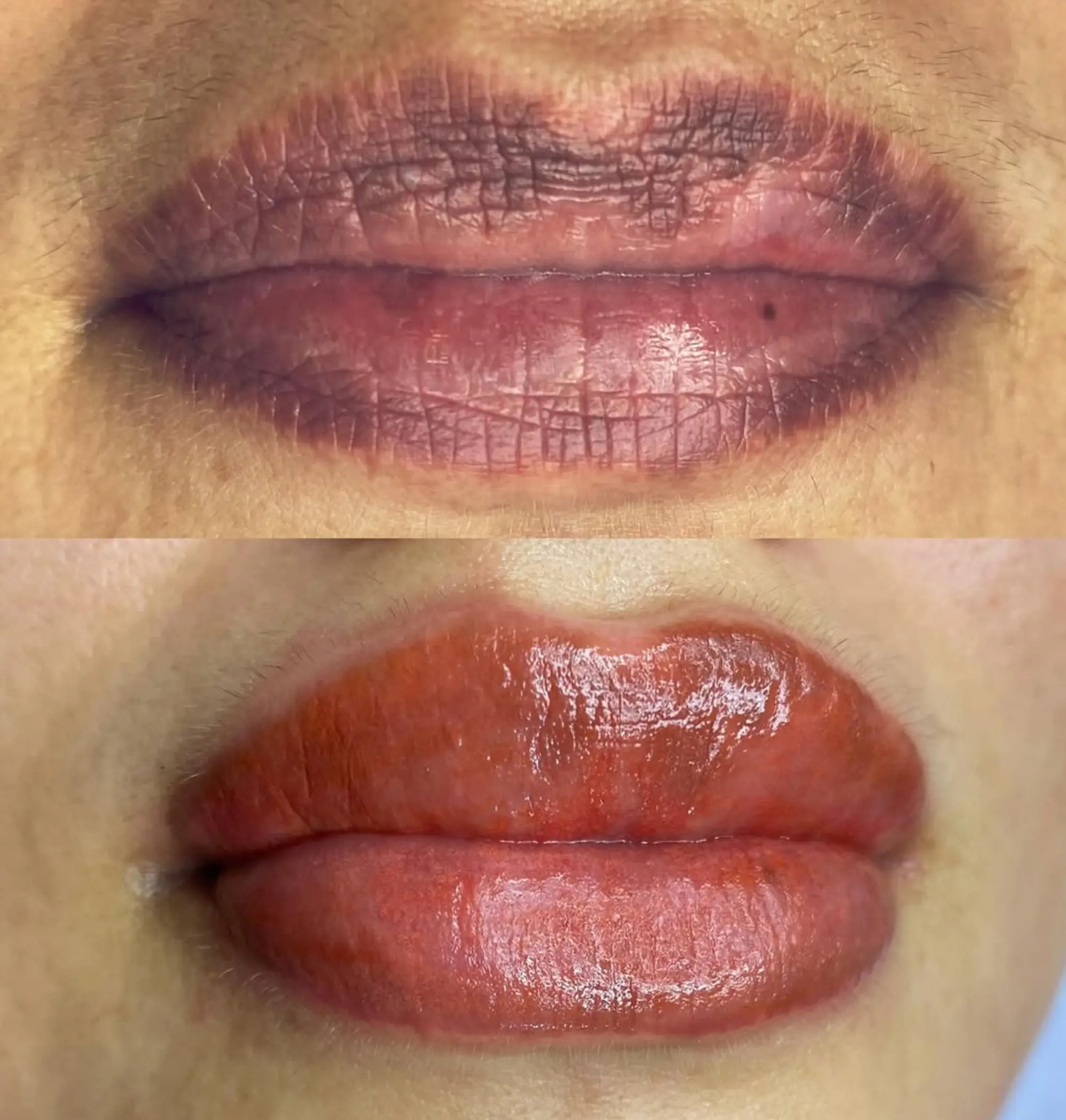 Lip Neutralisation and PIH Safety