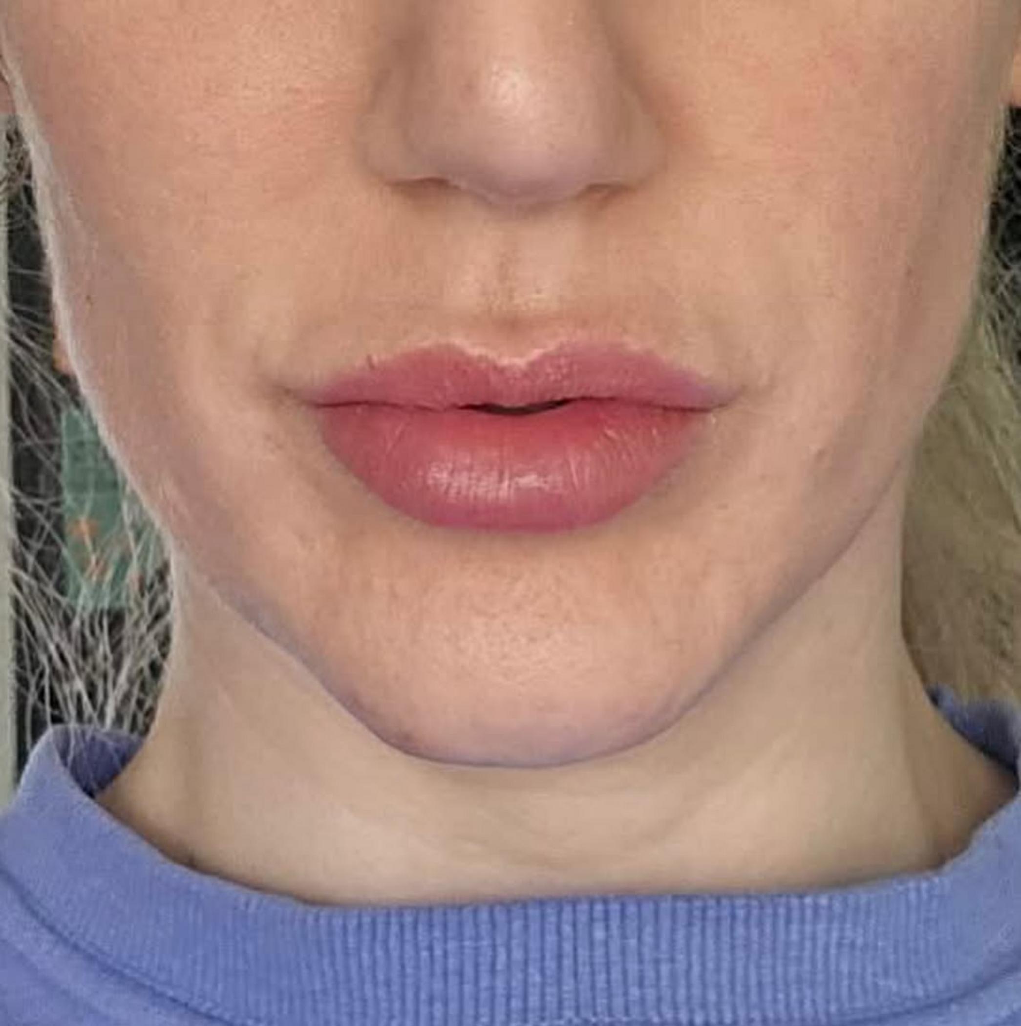 Do Lip Plumpers Degrade Lip Pigment?
