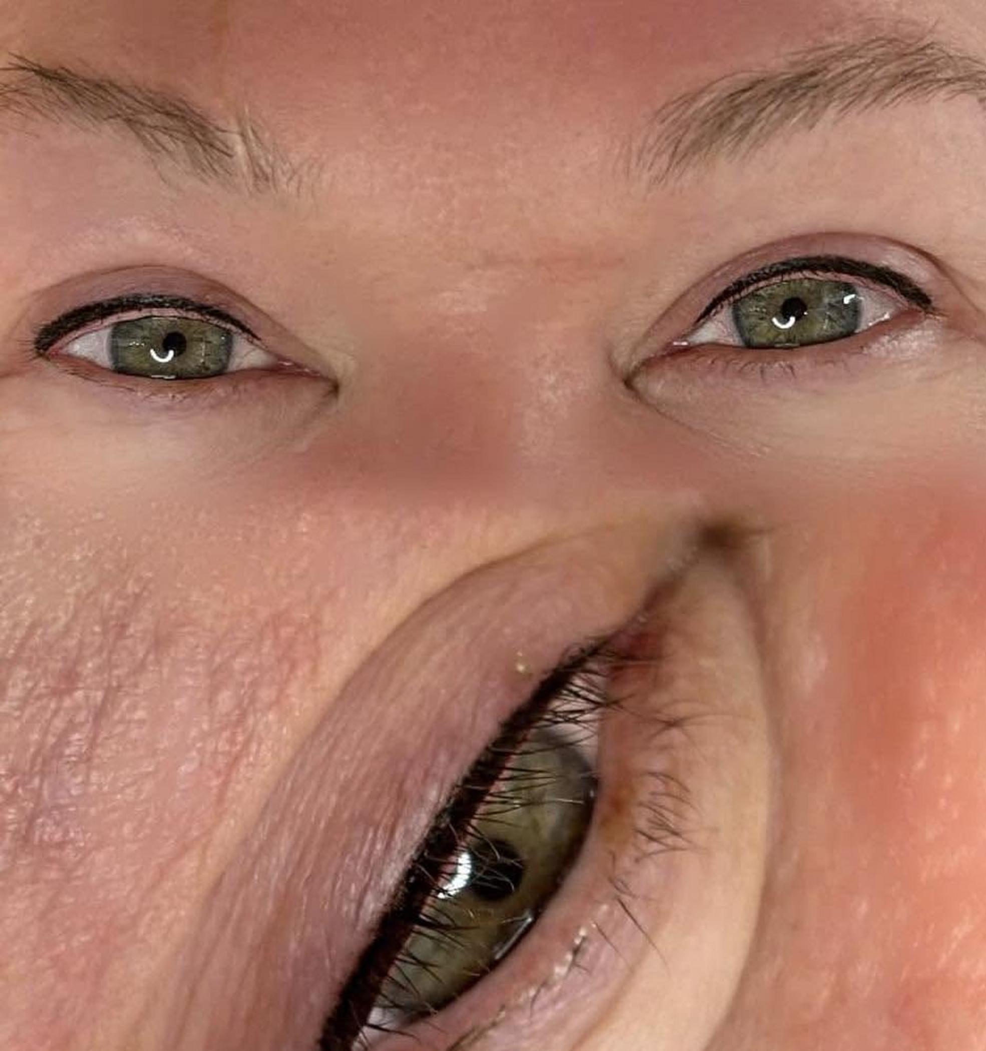 eyeliner tattoo procedure in progress