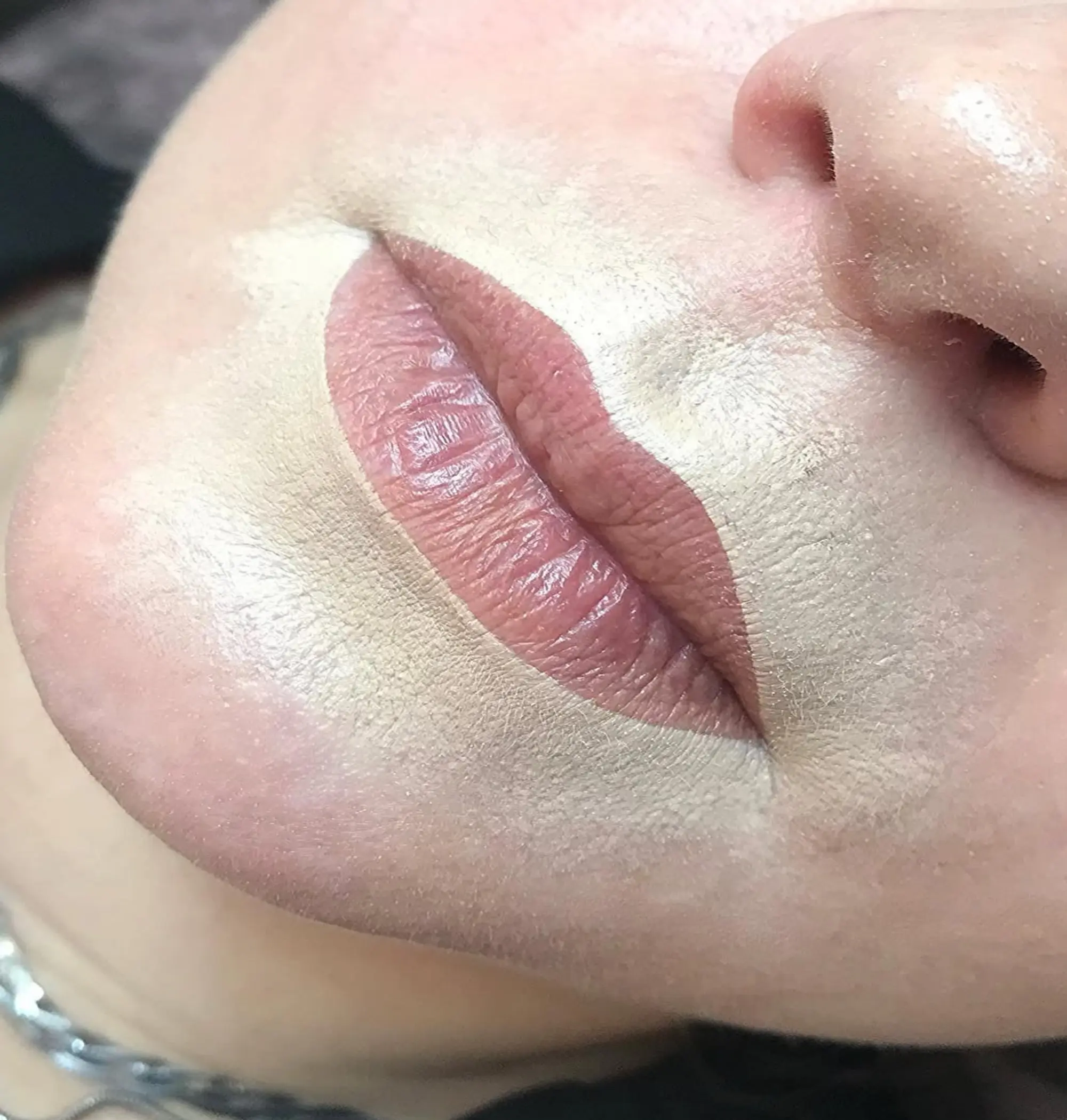 Can Lip Blush Migrate After Filler?